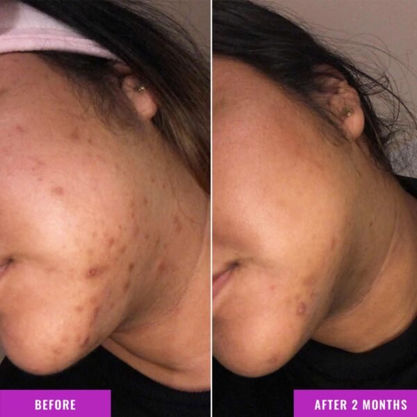 Good Molecules Discoloration Correcting Serum - Tranexamic Acid and Niacinamide Serum to Target Dark Spots and Hyperpigmentation - Skin Care for Face